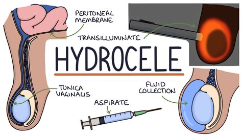 testicular torsion hydrocele